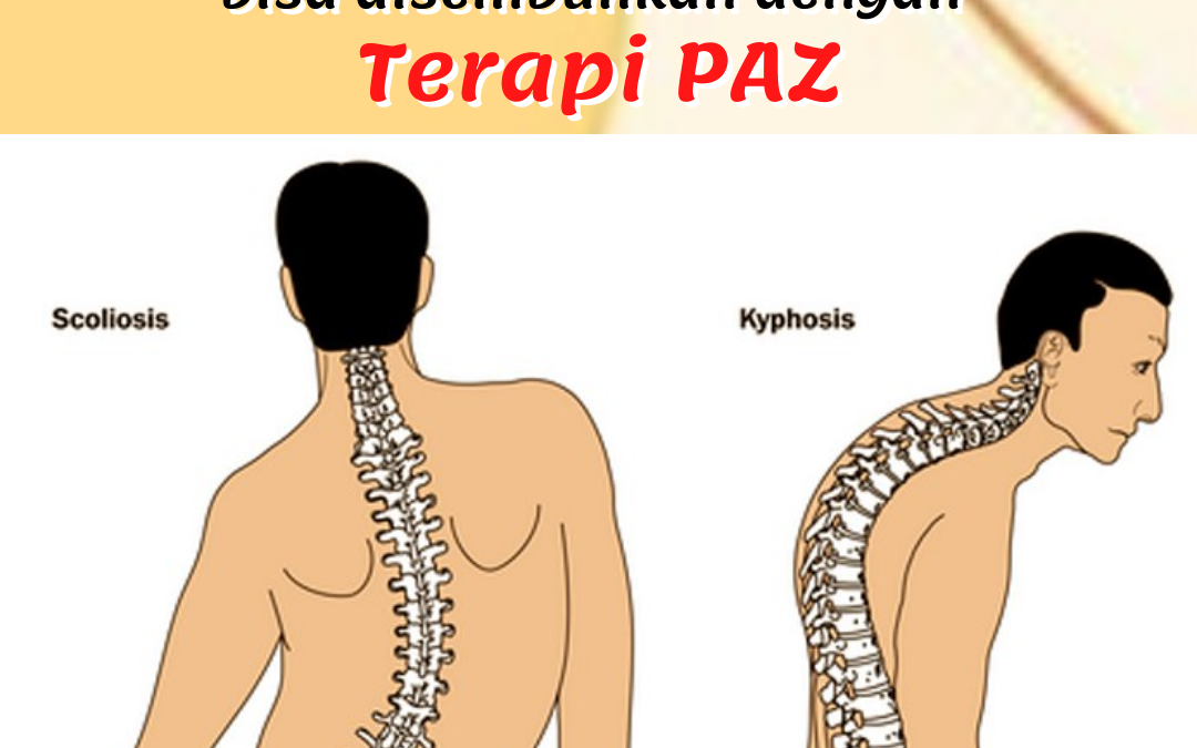 Kelainan Tulang Belakang Skoliosis Sembuh Dengan Terapi PAZ