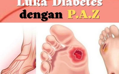 Luka Diabetes dengan Terapi PAZ Al Kasaw